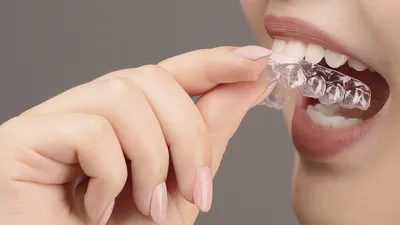 Элайнеры для зубов | DentalKnysh Стоматология во Львове