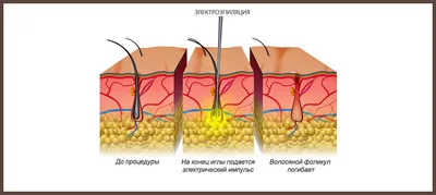 Электроэпиляция - «Электроэпиляция с хорошим мастером работает на 100% » |  отзывы