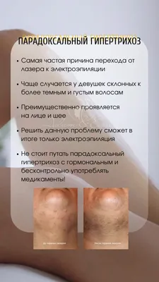 Электроэпиляция бикини