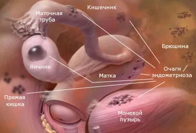 Удаление эндометриоза шейки матки – Сеть медицинских центров \"Лазер+\" по  удалению в СПБ