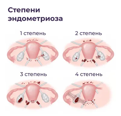 Эндометриоз 2 степени - симптомы, лечение, операция. - Хирург К. В. Пучков