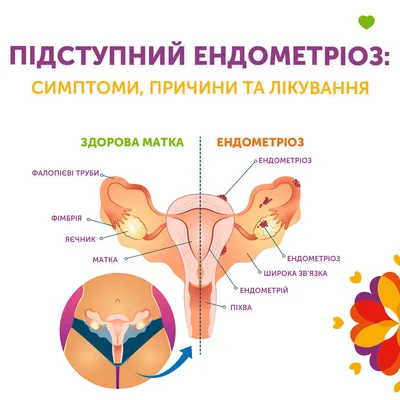 Наружный генитальный эндометриоз - причины, признаки и симптомы у женщин