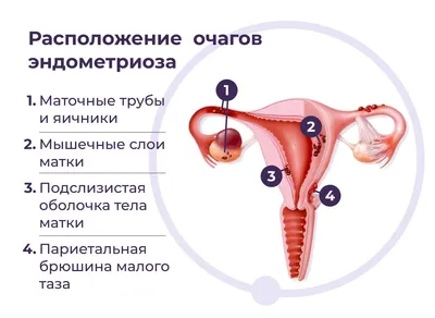 ЭНДОМЕТРИОЗ симптомы и лечение | Клиника лечения эндометриоза