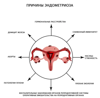 ⚕ Коварный эндометриоз: симптомы, причины и лечение - PULSE