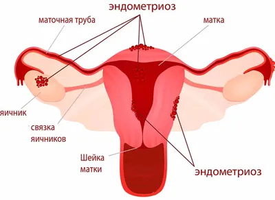 Лечение бесплодия при эндометриозе | Клиника Феськова А.М.