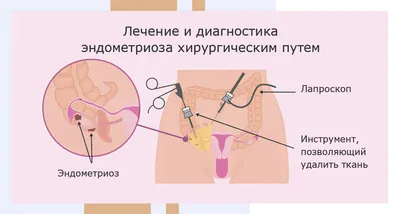 Эндометриоз - причины появления, симптомы заболевания, диагностика и  способы лечения