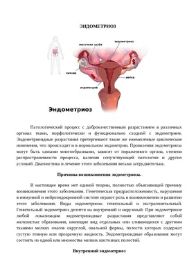 ginekolog_akbermet - МИФЫ ВОКРУГ ЭНДОМЕТРИОЗА ⠀ 🤔Эндометриоз – сложное и  неоднозначное заболевание, вокруг которого существует большое количество  мифов и заблуждений. ⠀ Не одно поколение медиков ломает голову над решением  диагностических и лечебных