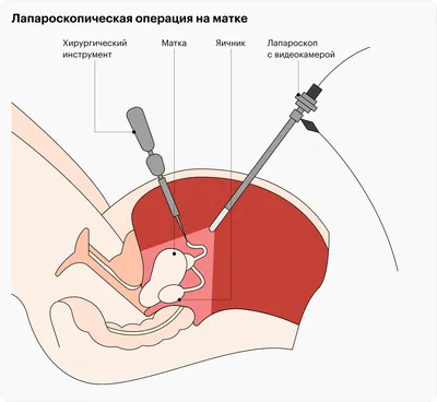 ЭНДОМЕТРИОЗ ⁂ симптомы эндометриоза матки, шейки ▷ фото ▷