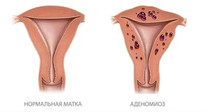 Эндометриоз: что это, симптомы, причины, диагностика и лечение, как выглядит