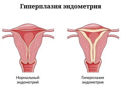 Эндометриоз – проблема, у которой есть решение - БСМП Гродно