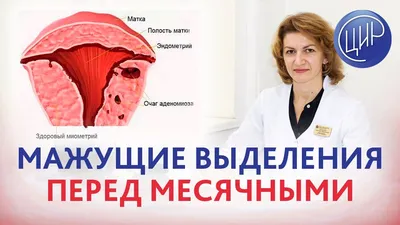 Эндометриоз матки: симптомы, причины, лечение