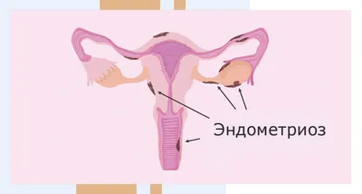 Лечение эндометриоза без гормонов. Возможно – тема научной статьи по  клинической медицине читайте бесплатно текст научно-исследовательской  работы в электронной библиотеке КиберЛенинка