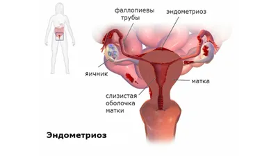 Наружный генитальный эндометриоз - причины, признаки и симптомы у женщин