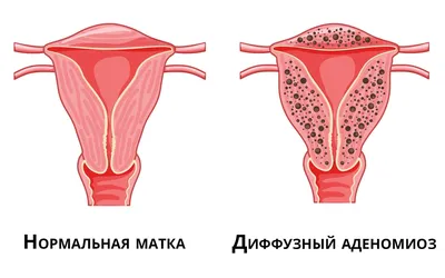 Эндометриоз: полезно знать