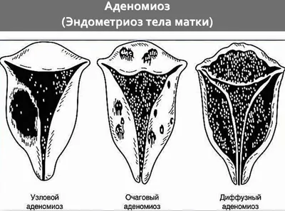 Эндометриоз: что это такое, типы, причины, симптомы, профилактика