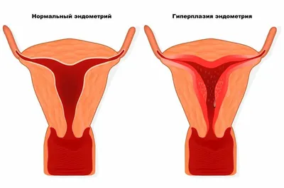 Диффузный аденомиоз матки: причины, симптомы, признаки, лечение