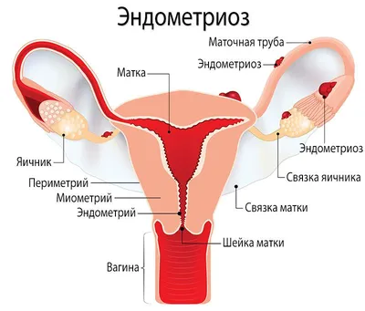 Лечение эндометриоза ❤️ Цены на диагностику и лечение эндометриоза матки в  Киеве ❤️ Отзывы пациентов