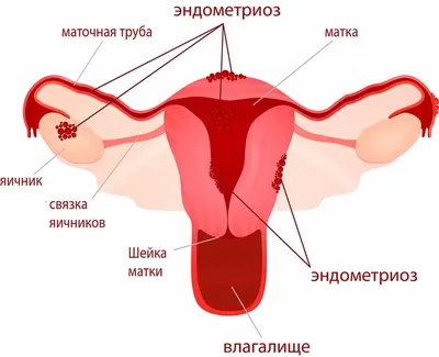 Эндометриоз: лечение, диагностика, операция по удалению эндометриоза