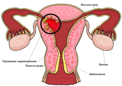 Эндометриоз матки – симптомы, лечение, диагностика