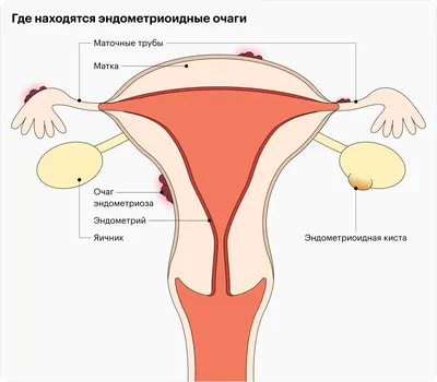 Эндометриоз: что это, симптомы, причины, диагностика и лечение, как выглядит