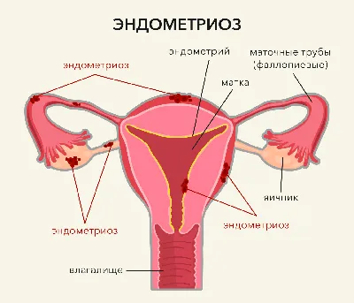 Эндометриоз: симптомы, диагностика, лечение и профилактика заболевания