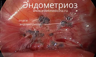 Эндометриоз: лечение, клиника, отзывы | Интернет-журнал Estetmedicina.ru