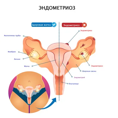 Эндометриоз - причины появления, симптомы заболевания, диагностика и  способы лечения