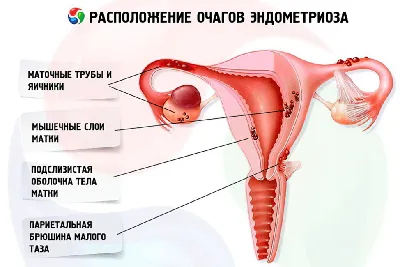 Эндометриоз: причины и лечение 🌺 – Юнона