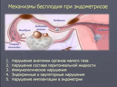 Эндометриоз: лечение, диагностика, операция по удалению эндометриоза