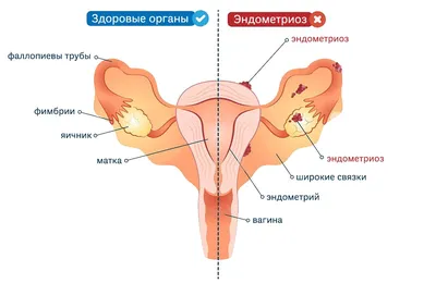 ➡️ Эндометриоз, симптомы и лечение, причины заболевания у женщин и мужчин -  клиника Девита (Devita)