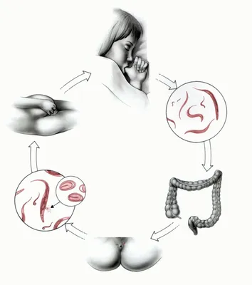 Симптомы энтеробиоза у детей и взрослых, лечение и профилактика:Как  распознать энтеробиоз,Причины заражения,Методы диагностики | doc.ua