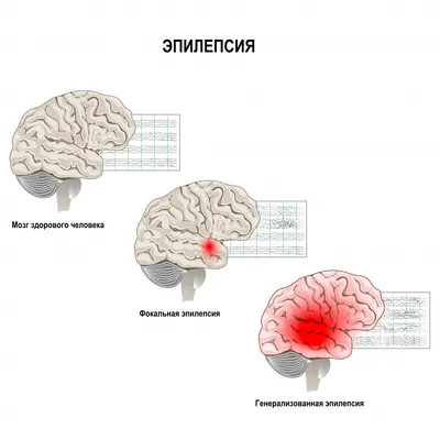 Эпилепсия картинки