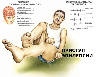 Эпилепсия. Приступ эпилепсии — его причины, признаки и симптомы.