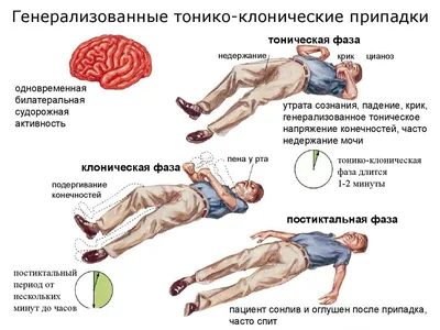 ЭЭГ. Эпилепсия | Электроэнцефалография | Дзен