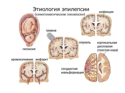 Эпилепсия у детей