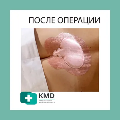 Эпителиальный копчиковый ход (ЭКХ) | Первый клинический медицинский центр |  Дзен