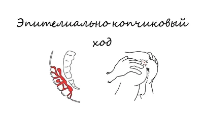 Эпителиальный копчиковый ход (пилонидальная киста) - узнайте вместе с  Мединой