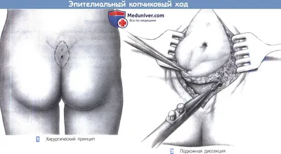 Эпителиальный копчиковый ход – удаление кисты копчика — Медицинский центр  «Целитель»