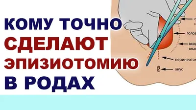 Эпизиотомия при родах - «❤ ❤ ❤ Эпизиотомия - Больно или нет? Как долго  заживает шов после эпизиотомии. Эпизиотомия и секс. Внешний вид зажившего  шва ФОТО ❤ ❤ ❤» | отзывы