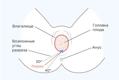 Эпизиотомия фото