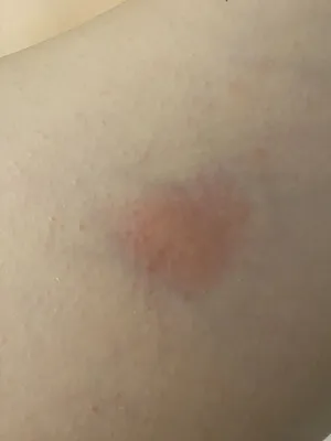 Инфекционная эритема (Erythema infectiosum)