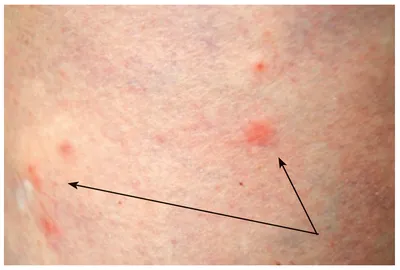 Erythema nodosum as Leprosy reaction - Semenova - Vestnik dermatologii i  venerologii