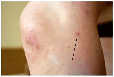 Erythema nodosum as Leprosy reaction - Semenova - Vestnik dermatologii i  venerologii