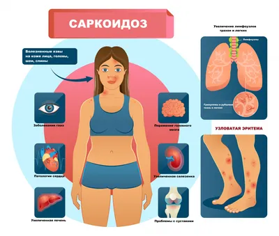 Многоформная экссудативная эритема. От маленьких язв до летального исхода  :- Medznat