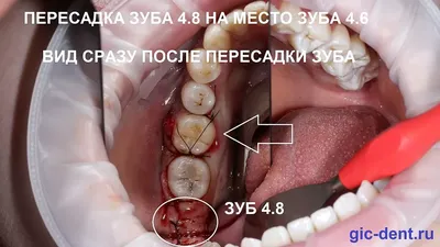 Имплантация собственных зубов. Пересадка зубов мудрости в ТОП1 клинике  Москвы – Немецкий имплантологический центр