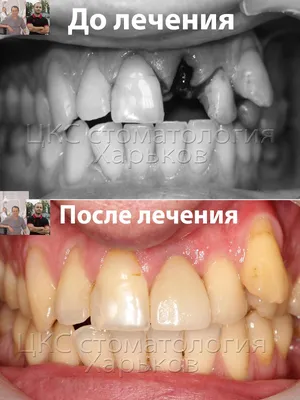 Экспресс имплантация, клинический случай в ЦКС - г. Харьков