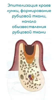 Этапы заживления лунки после удаления зуба. Записи блога