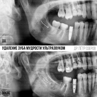 Удаление ретинированного зуба мудрости ультразвуком Piezosurgery