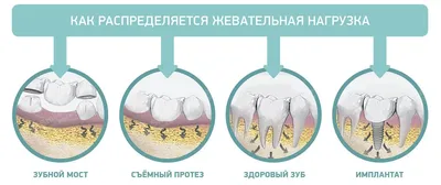 После удаления зубов: образ жизни, питание и правила гигиены - рекомендации  специалистов