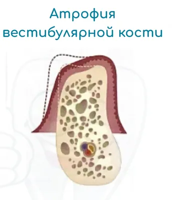 Киста зуба и имплантация - Cтоматология Май